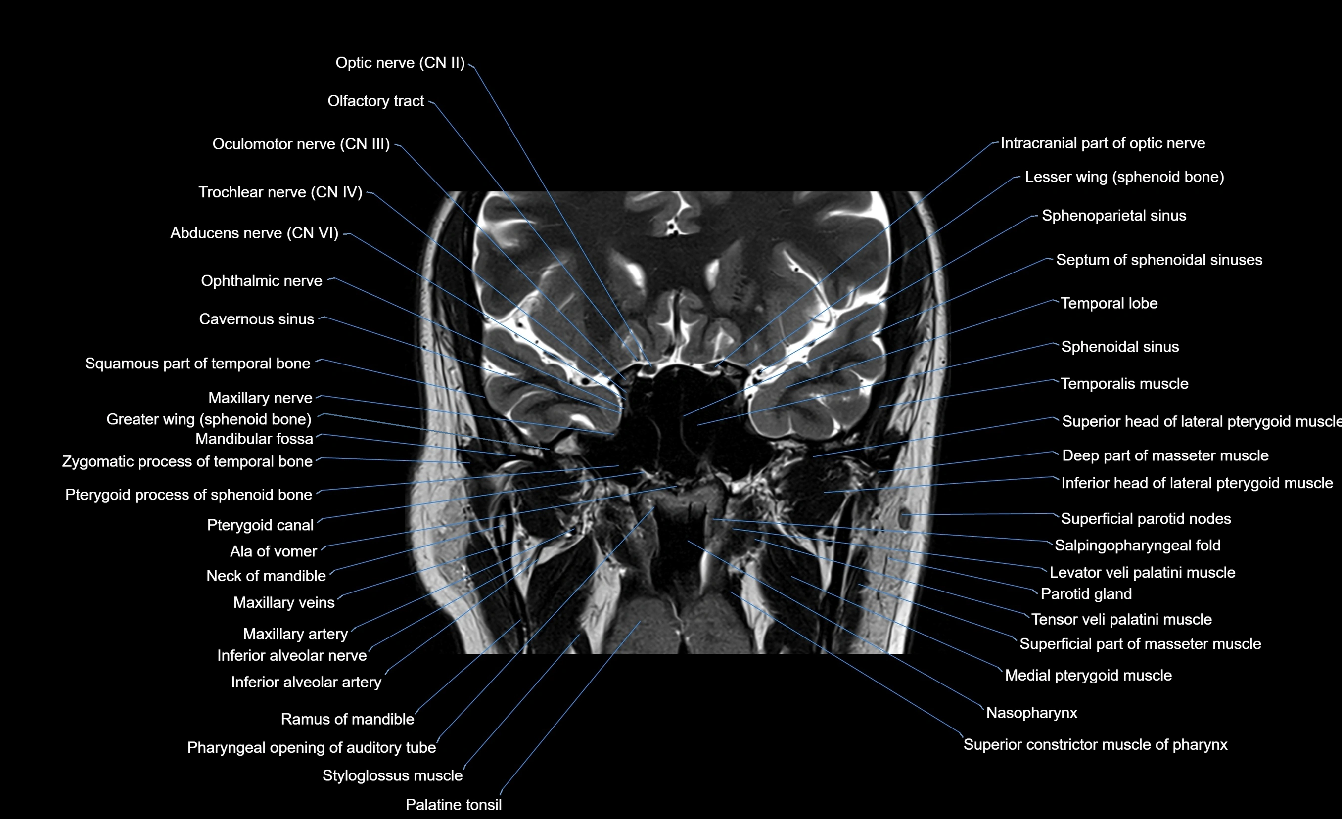 MRI face & paranasal sinuses(PNS) labelled  coronal  cross sectional anatomy 3T radiology  image-img-00001-00033.webp